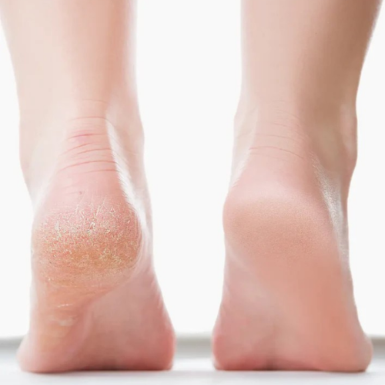 SoftStep Elektrische Eeltverwijderaar | Voor verzorgde & gladde voetzolen zonder eelt