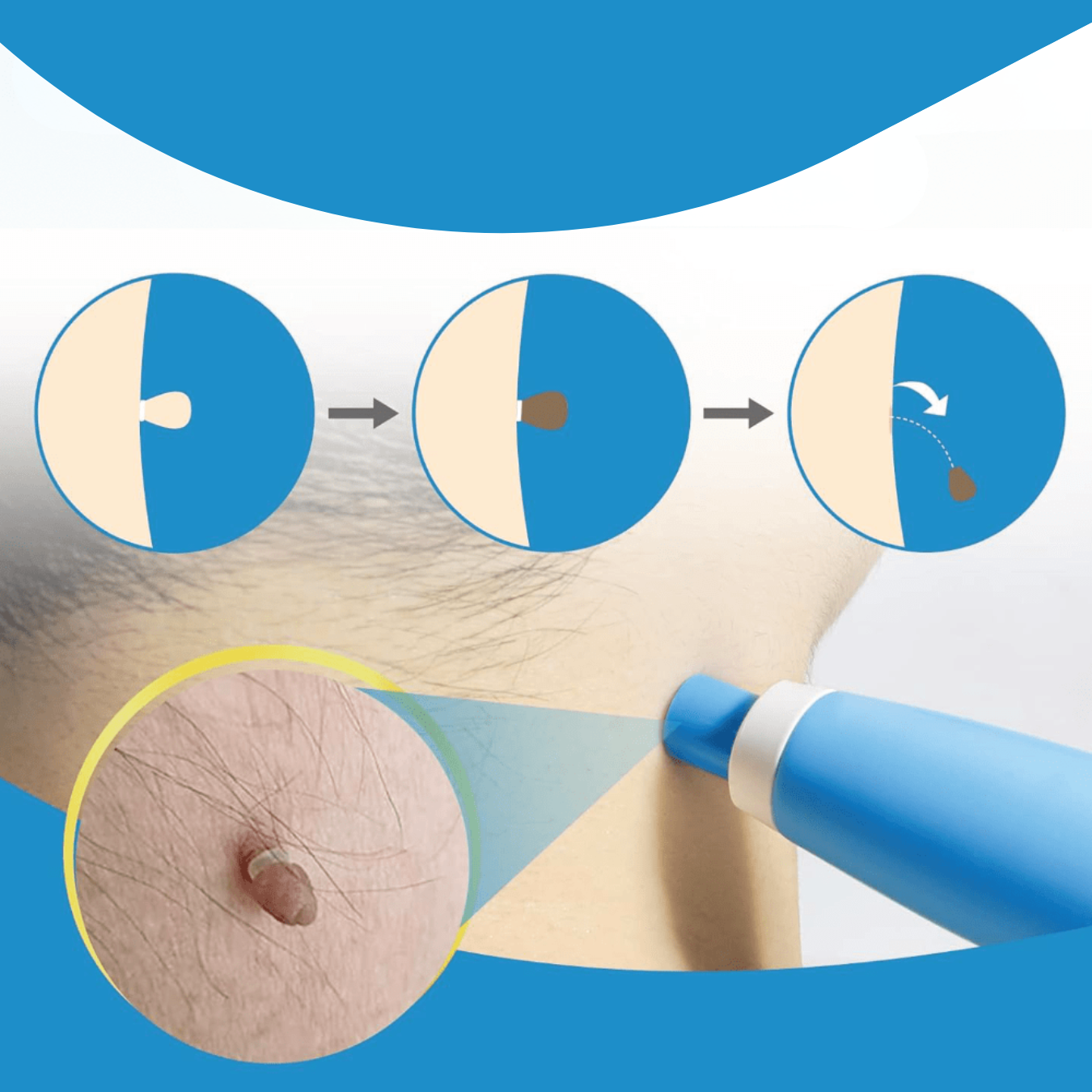 WratStop Steelwrat Verwijderaar | Pijnloos voor Gezicht & Lichaam