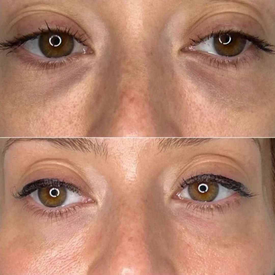 Oogpatches | Tegen Donkere Kringen, Vermoeidheid & Rimpels