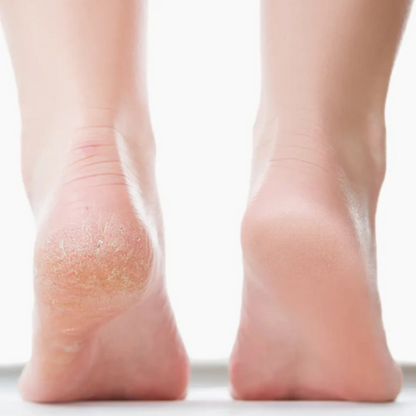 SoftStep Elektrische Eeltverwijderaar | Voor verzorgde & gladde voetzolen zonder eelt