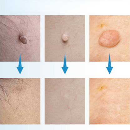 WratStop Steelwrat Verwijderaar | Pijnloos voor Gezicht & Lichaam