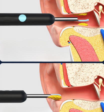 EarVision Pro Oorcamera met Licht & App | Voor eenvoudige & hygiënische oorreiniging