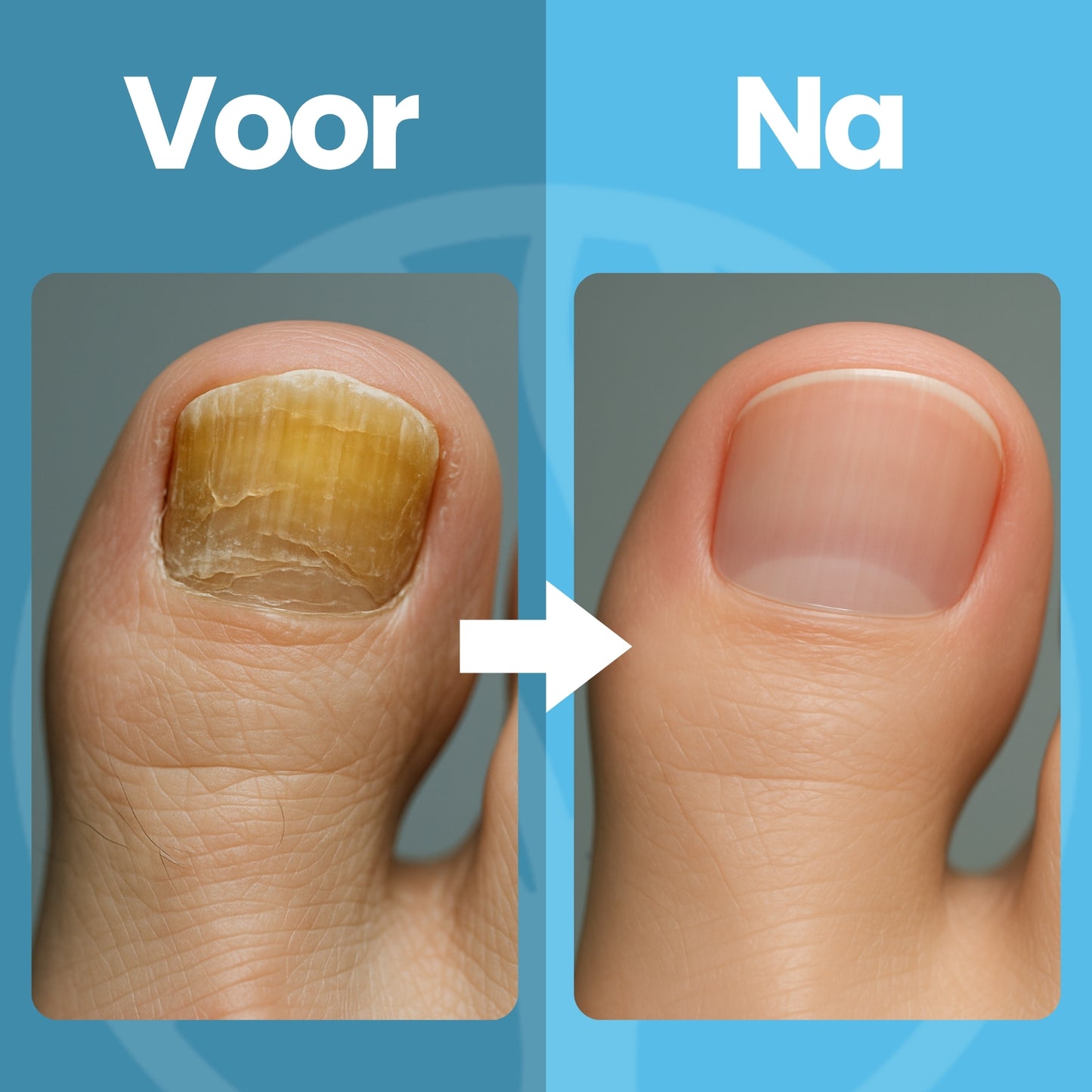 Fittershape Nail Renew | Lichttherapie Voor Gezonde Teennagels