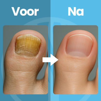 Fittershape Nail Renew | Lichttherapie Voor Gezonde Teennagels