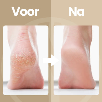 Fittershape SmoothStep Pro | Elektrische Voetvijl – Voor Gladde Hielen