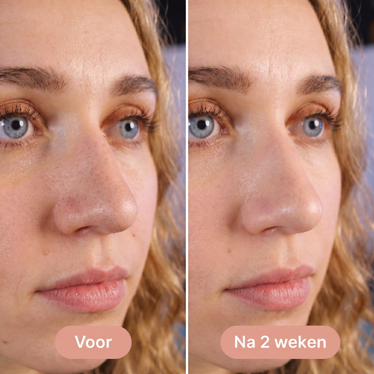 Fittershape Hydrocolloid Neuspleisters